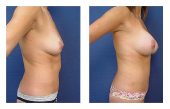 Breast Augmentation Orange County