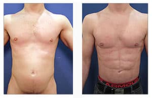 Male Breast Surgery Recovery