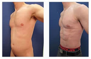 Male Breast Surgery Recovery Body by Our Surgical Team