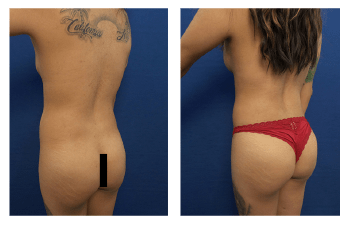 Liposuction and BBL