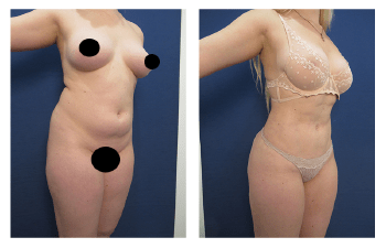 Liposuction Beverly Hills