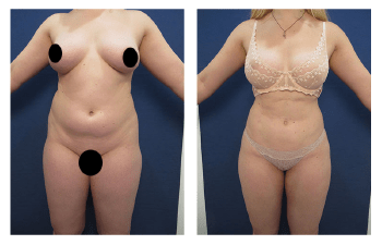 Best Liposuction Los Angeles & Beverly Hills, CA