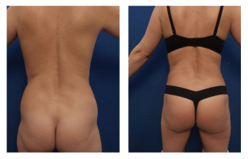 brazilian butt lift before and after