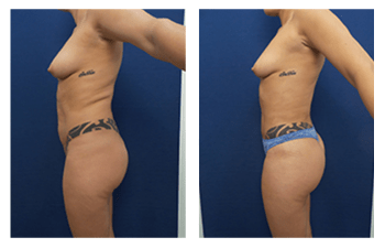 Liposuction vs. Smartlipo™