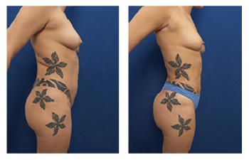 VASER Lipo vs. Smart Lipo  Cosmetic plastic surgery institute