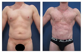 Patient 149284217  Body Etching (High-Def Lipo) Before & After