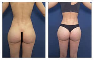 brazilian buttock lift surgery before and after