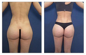 brazilian buttock lift surgery before and after