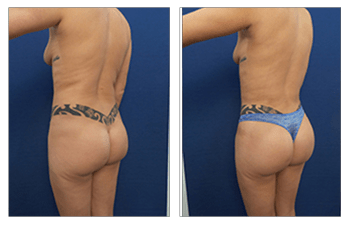 Brazilian Butt Lift Side Effects - Halifax, NS Liposuction Body Contouring  and Sculpting