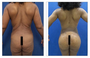 Buttock Implant, Fat transfer