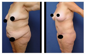 Tummy Tuck Surgery: Cost, Reviews, Before & After Los Angeles