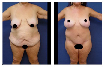 Mini Tummy Tuck Results  Cosmetic Plastic Surgery Institute