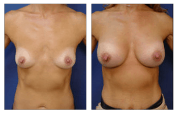 Breast Augmentation Orange County, CPSI.