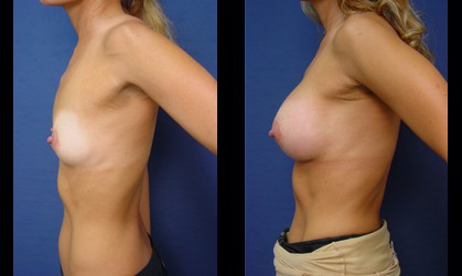 Breast Surgery Los Angeles
