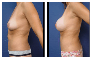 High definition liposuction San Diego