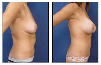 breast augmentation Newport Beach
