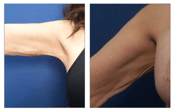 Arm Lift Surgery Without A Scar