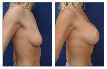 Breast Augmentation Surgery, CPSI.