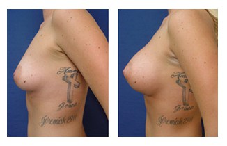 Breast Augmentation Surgery Price Cosmetic Plastic Surgery