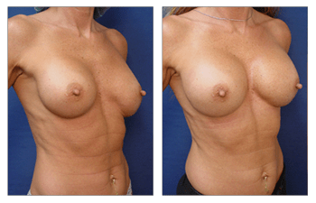 breast augmentation surgery patient 11 front right view