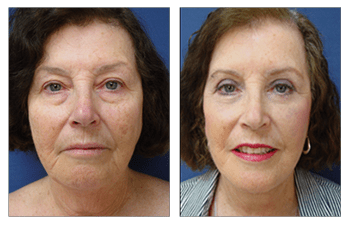 More confident': 70-year-old woman shares youthful look after cosmetic  treatment