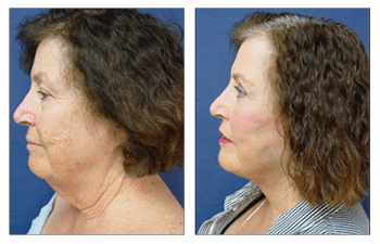 Facelift Before And After