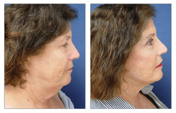 Facelift Before And After