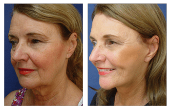 facelift procedure Dana Point