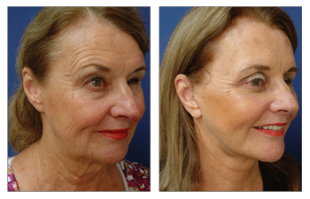 facelift procedure Los Angeles