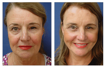 rejuvenated face Newport Beach