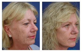 Facelift Pictures Right After Surgery