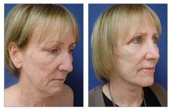 Mini Facelift Before and After Pictures