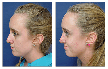 Closed Rhinoplasty Cosmetic Plastic Surgery Institute