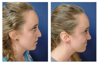 Is Closed Rhinoplasty Cheaper Than Open Our Surgical Team