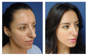 Open Rhinoplasty Incision