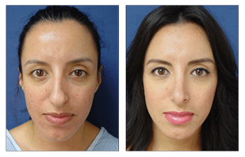 Beverly Hill Rhinoplasty