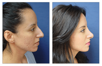 Newport Beach nose job