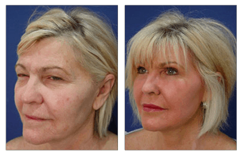 Facelift without Surgery!  Instant Facelift Over 50 