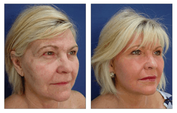 Face lift without surgery