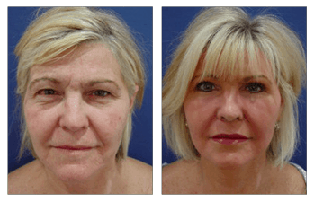 Face lift without surgery