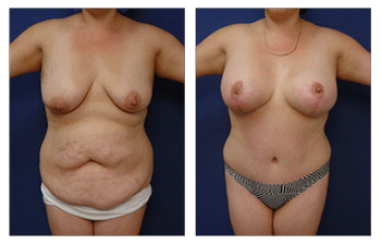 Breast Lift, Newport Beach, CA