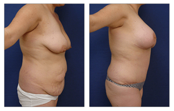 Breast Lift Orange County  After Surgery Instructions - Newport Beach -  Cruise Plastic Surgery