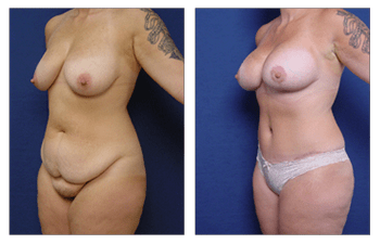 liposuction Los Angeles 