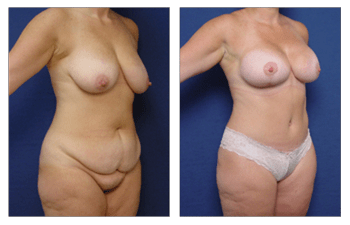 breast augmentation laguna beach