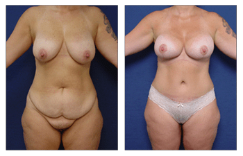 tummy tuck newport beach