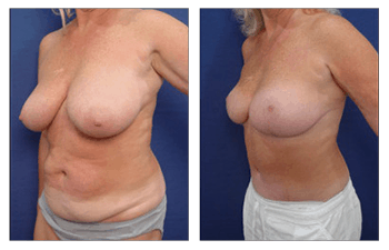 augmentation, body, procedures,