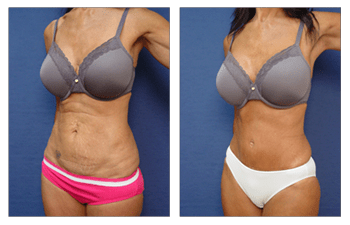 High Definition Brazilian Buttocks Lift (Buttocks shaping)