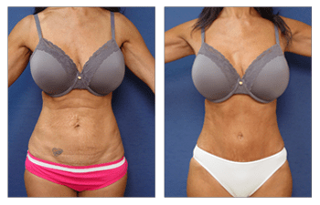 Tummy Tuck Recovery