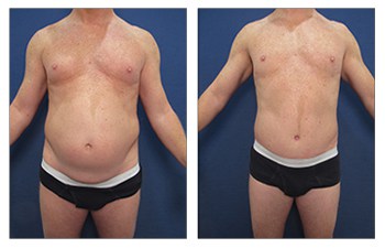 Abdominoplasty Tummy Tuck Surgery With Guy Sterne