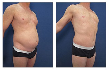 Tummy Tuck for Men Cosmetic Plastic Surgery Institute